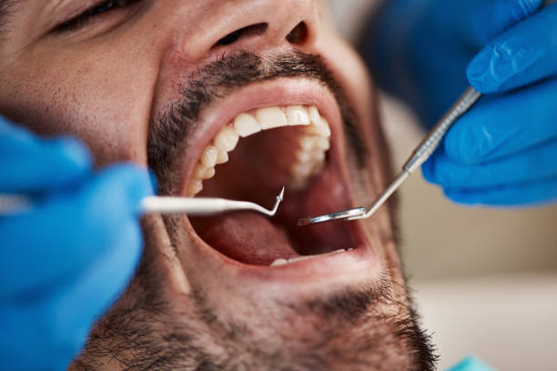 Best Emergency Dental Care for Broken or Chipped Teeth in Chester, CA
